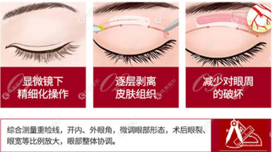 美杜莎双眼皮手术 美杜莎双眼皮手术
