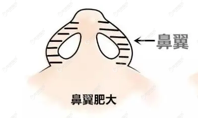单纯做鼻翼缩小可能鼻翼越来越大 单纯做鼻翼缩小可能鼻翼越来越大