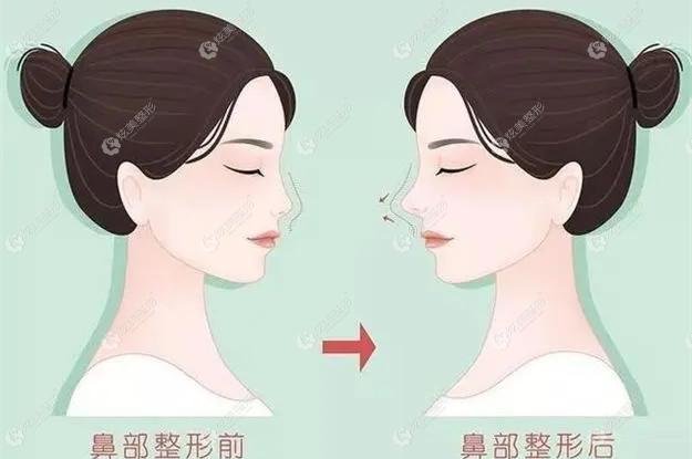 田芳斌医生做鼻综合手术的实例 田芳斌医生做鼻综合手术的实例