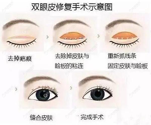 王金红医生做双眼皮修复原理www.17qzx.com 王金红医生做双眼皮修复原理www.17qzx.com