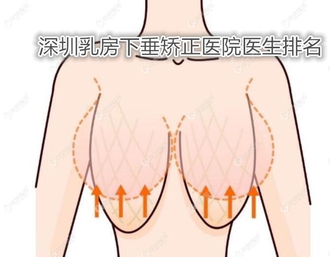 深圳乳房下垂矫正医院医生排名：深圳南雅、美莱、军科做胸提升比较好