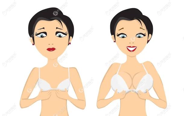 宝俪和曼托假体隆胸后的胸部变化 宝俪和曼托假体隆胸后的胸部变化