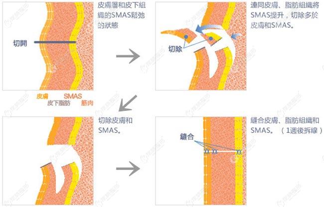 筋膜悬吊除皱手术的原理图 筋膜悬吊除皱手术的原理图