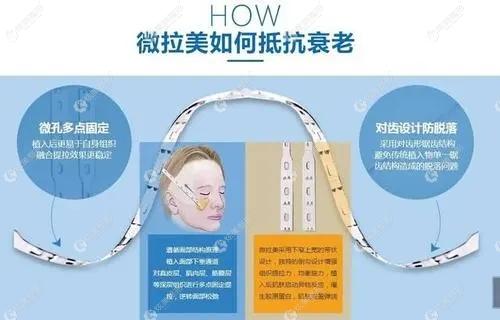 微拉美面部提升手术的优势点www.17qzx.com 微拉美面部提升手术的优势点www.17qzx.com