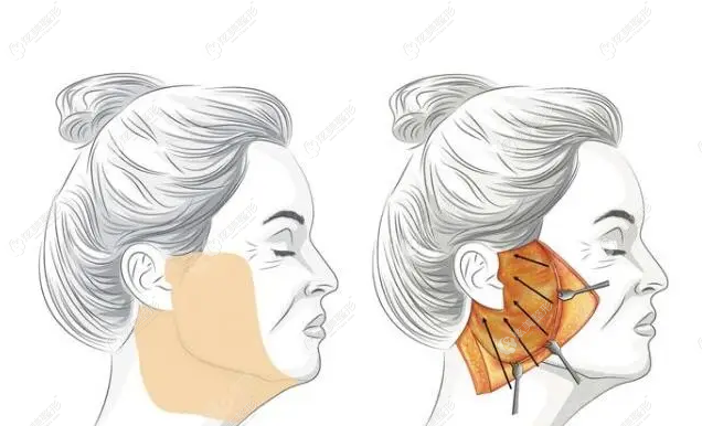 大拉皮手术的原理图 大拉皮手术的原理图