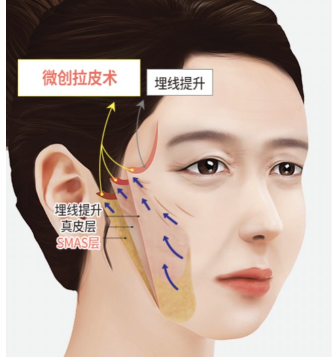 北京华韩整形医院拉皮如何预约挂号