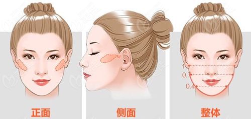 成都颧骨整形医院排名出炉
