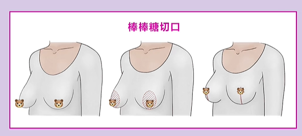 二、胸部双环悬吊是持久的吗?疗效维持时间受3个因素影响