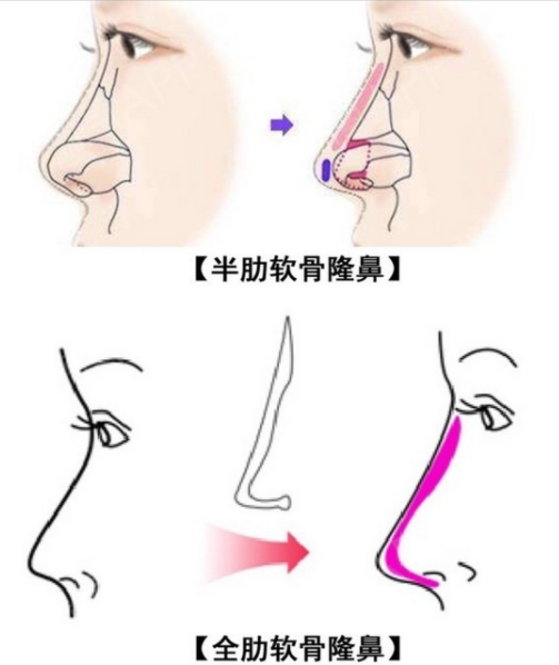 三、武汉杨乐隆鼻多少钱不同材料对比www.17qzx.com