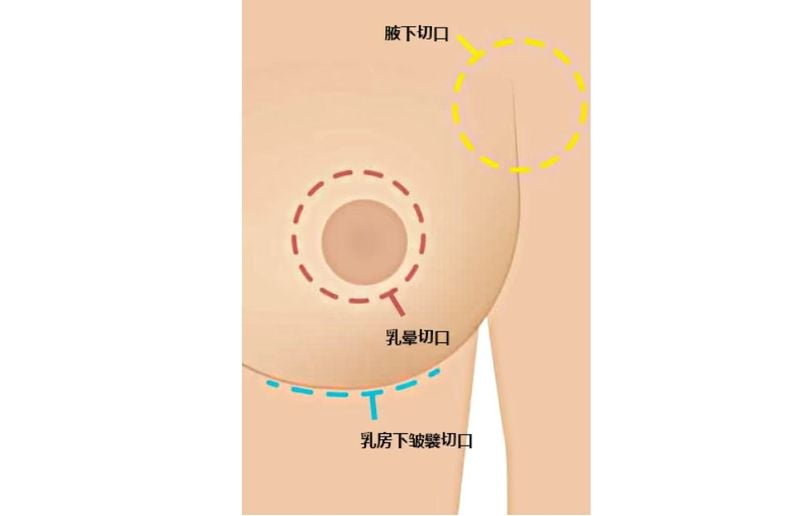 关于脂肪丰胸和假体丰胸哪个好,用户较常问的几个问题(FAQ)