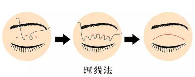 �人�Ͼ��������˫��Ƥ������ô������΢�ֲ��ϣ��ָ����ڶ�