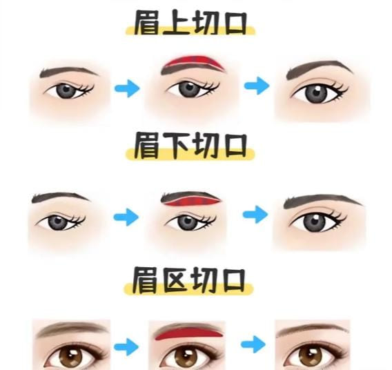 四、韩柏宏提眉适合什么人?眉眼松垂、双眼皮变窄的可面诊看